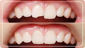 Composite Esthetic Filling