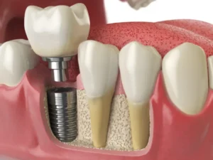 Dental Implant Surgeries