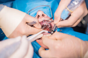 Oral & Maxillo-Facial Surgeries