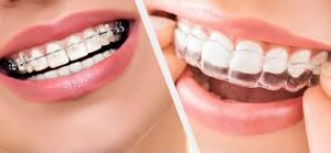 Orthodontic / Braces