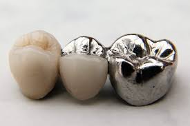 Ceramic and metal bridges