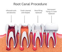 Root Canal