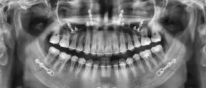 RVG X-ray